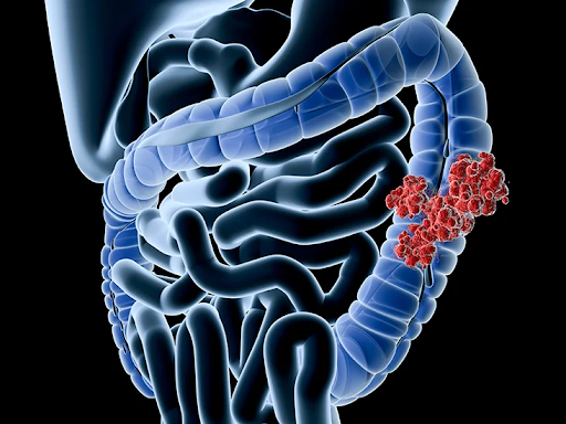 Is colon cancer curable?